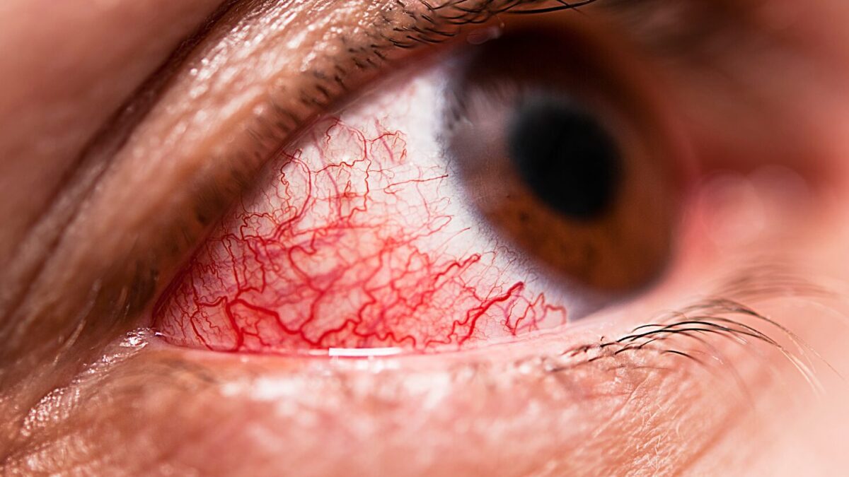 Mit Bindehautentzündung arbeiten: Was Sie wissen sollten und wie Sie sich richtig verhalten